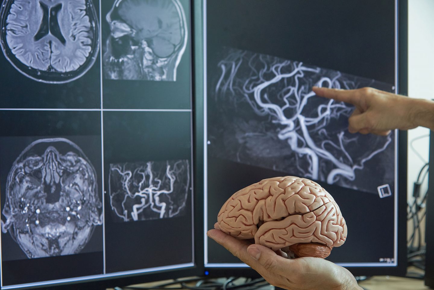 3T magnetska rezonanca mozga - Poliklinika Affidea Sveti Rok